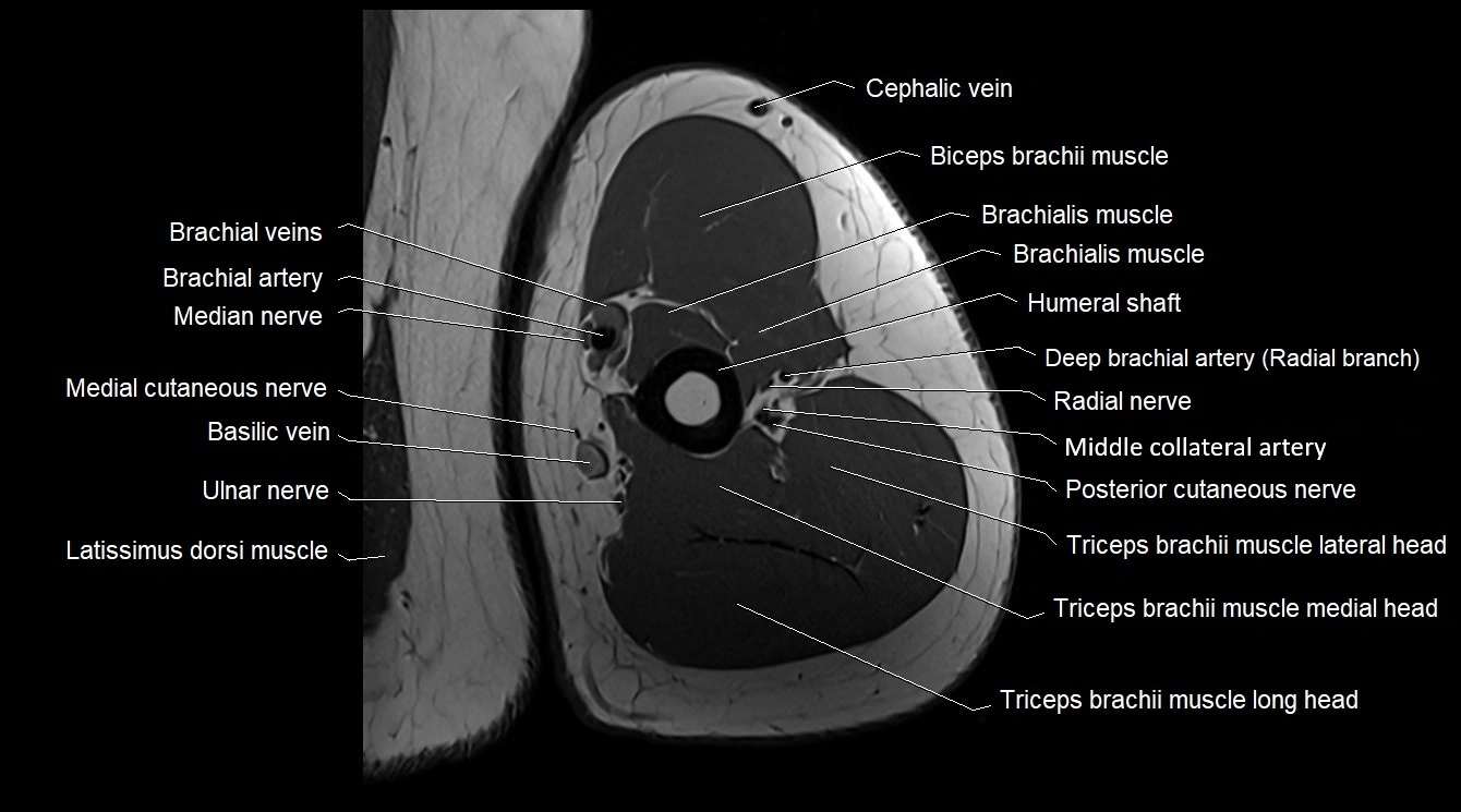 Upper arm( humerus) cross section anatomy MRI 3T axial image 37.webp